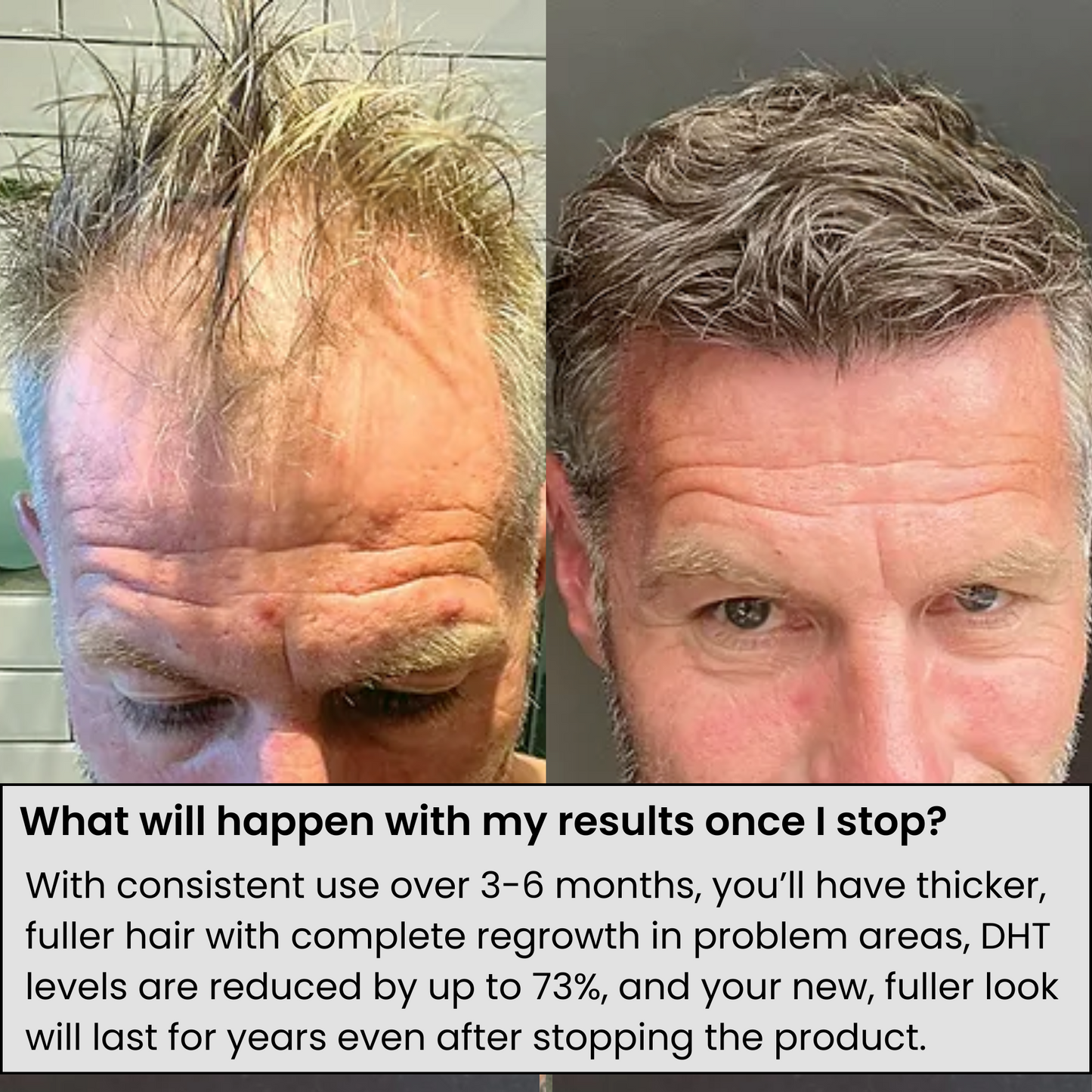 Voraid™ Alpha Hair Regrowth System
