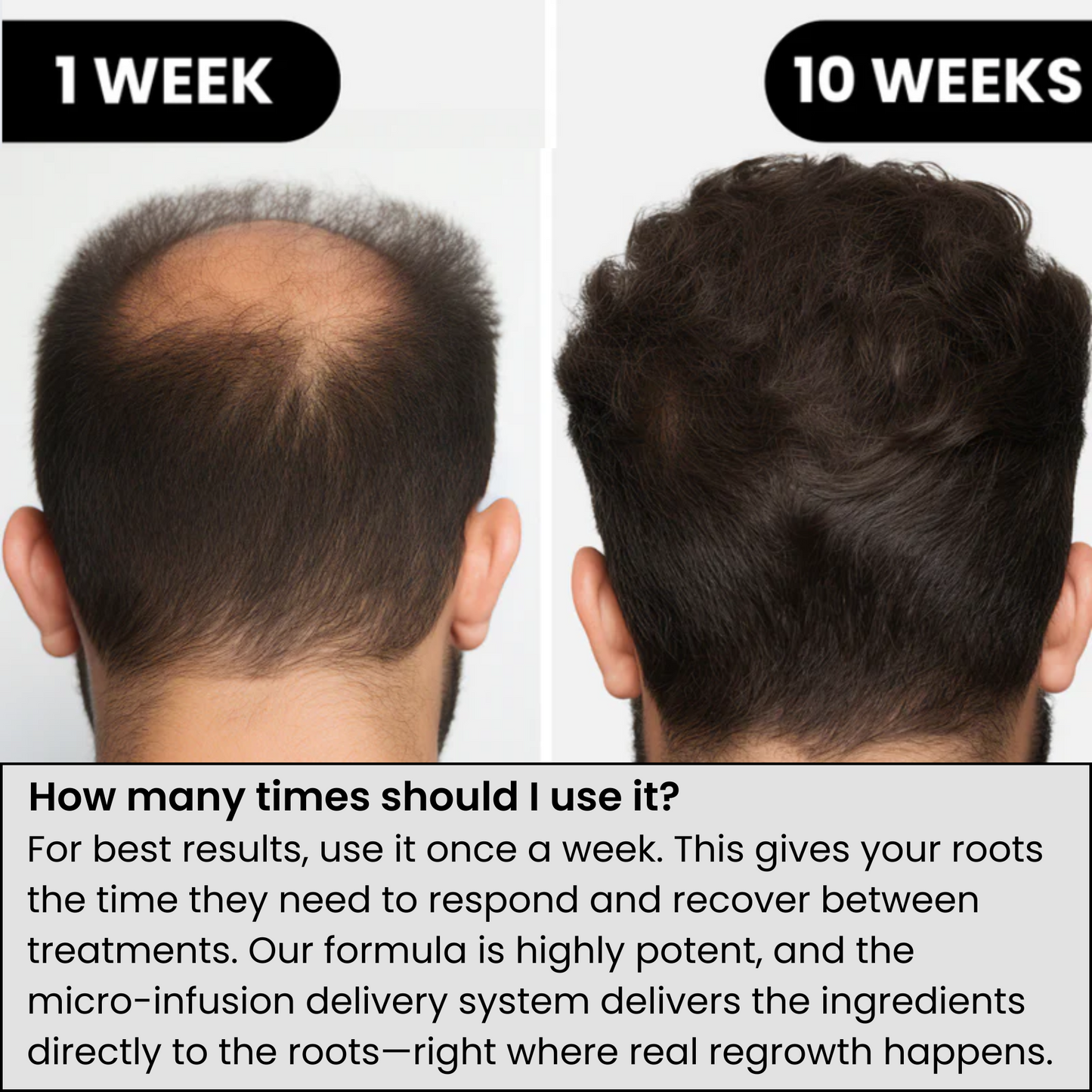 Voraid™ Alpha Hair Regrowth System