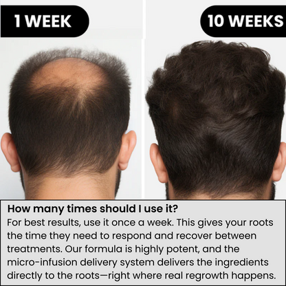 Voraid™ Alpha Hair Regrowth System